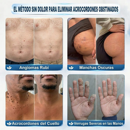 Instalación registrada ante COFEPRIS丨🧩 Eliminador de acrocordones y manchas en 7 días Pluma roll-on avanzada, sin dolor y sin dejar cicatrices