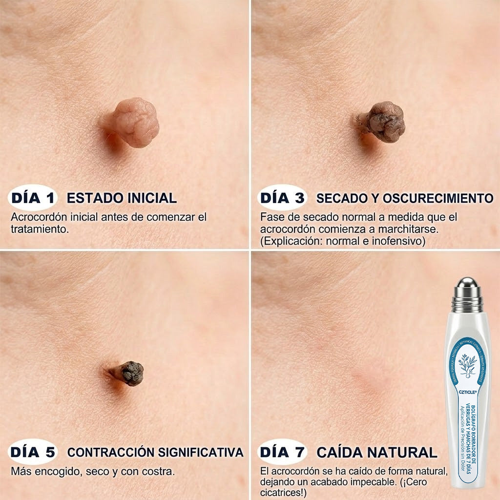 Instalación registrada ante COFEPRIS丨🧩 Eliminador de acrocordones y manchas en 7 días Pluma roll-on avanzada, sin dolor y sin dejar cicatrices