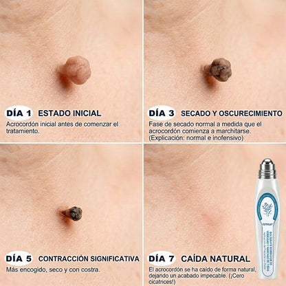 Instalación registrada ante COFEPRIS丨🧩 Eliminador de acrocordones y manchas en 7 días Pluma roll-on avanzada, sin dolor y sin dejar cicatrices