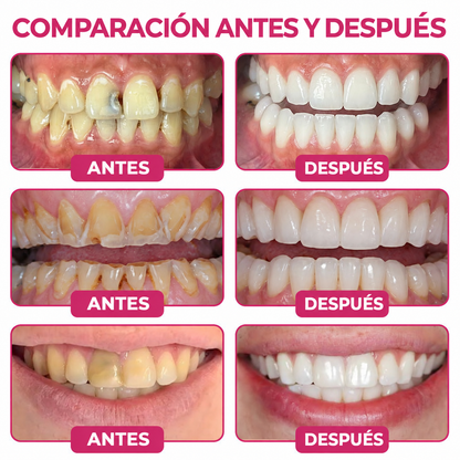 HEATWOLF® DenPerm Gel Rellenador para Reparación de Caries y Esmalte Dental Natural🎈