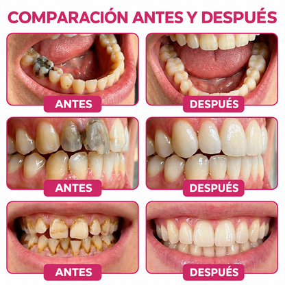HEATWOLF® DenPerm Gel Rellenador para Reparación de Caries y Esmalte Dental Natural🎈